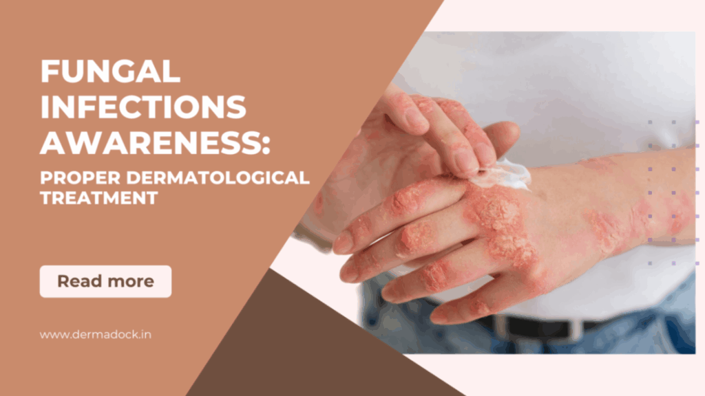 Fungal Infections Awareness: Proper Dermatological Treatment