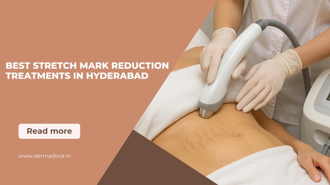 best-stretch-mark-reduction-treatments-in-hyderabad