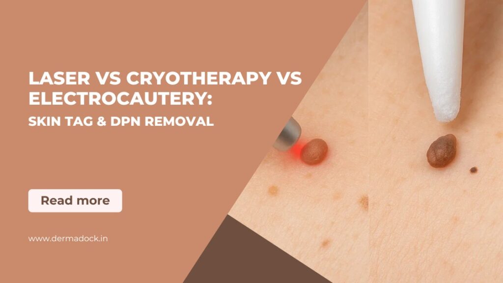 laser-vs-cryotherapy-vs-electrocautery-skin-tag-&-dpn-removal